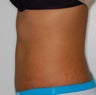Tummy tuck