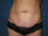 Tummy tuck