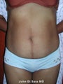 Tummy tuck