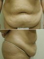 Tummy tuck