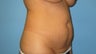 Tummy tuck