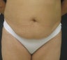 Tummy tuck