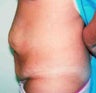 Tummy tuck