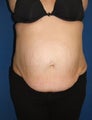 Tummy tuck