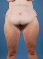 Tummy tuck