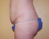 Tummy tuck