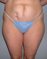 Tummy tuck
