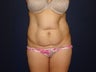 Tummy tuck