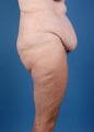 Tummy tuck