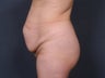 Tummy tuck