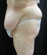 Tummy tuck