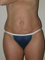 Tummy tuck