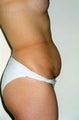 Tummy tuck