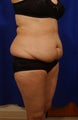 Tummy tuck