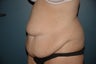 Tummy tuck