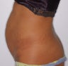 Tummy tuck