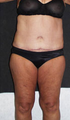 Tummy tuck