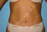 Tummy tuck