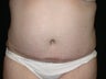 Tummy tuck