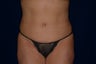 Tummy tuck