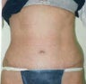 Tummy tuck