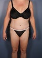 Tummy tuck