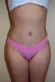 Tummy tuck