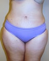 Tummy tuck