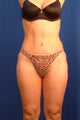 Tummy tuck