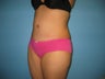 Tummy tuck