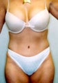 Tummy tuck