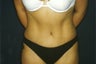 Tummy tuck