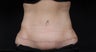 Tummy tuck