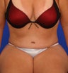 Tummy tuck