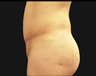 Tummy tuck
