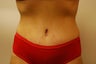 Tummy tuck