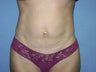 Tummy tuck
