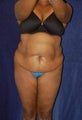 Tummy tuck