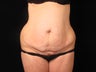 Tummy tuck