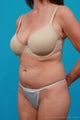 Tummy tuck