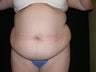 Tummy tuck