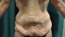 Tummy tuck