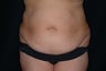 Tummy tuck