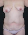 Tummy tuck