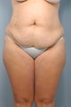 Tummy tuck