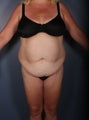 Tummy tuck