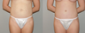 Tummy tuck