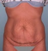 Tummy tuck