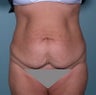 Tummy tuck