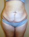 Tummy tuck